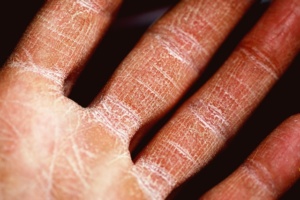 Dry Skin