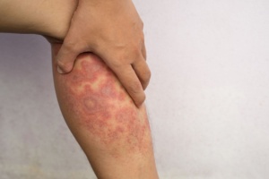 Dry Skin
