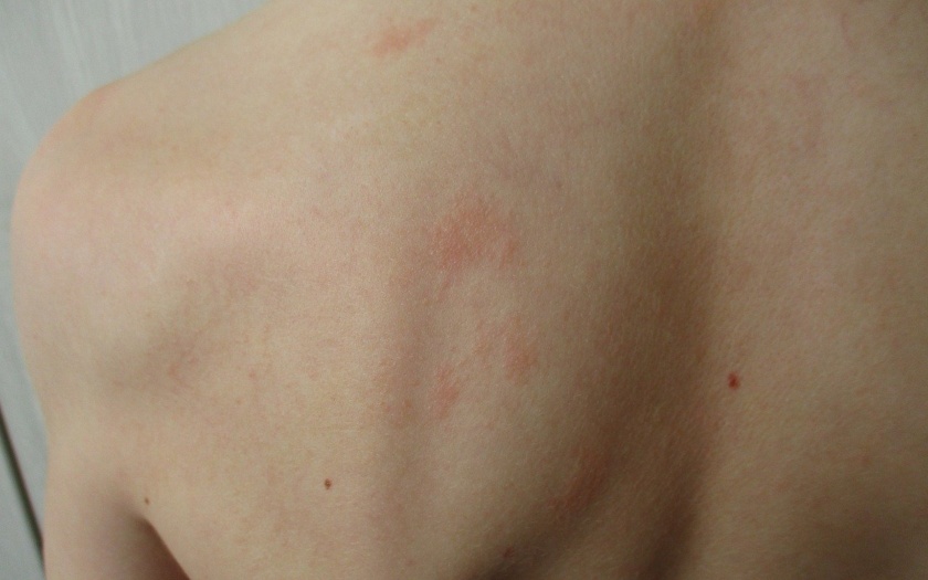 rash